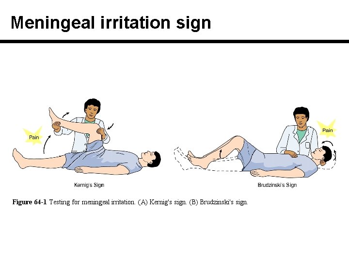 Meningeal irritation sign 