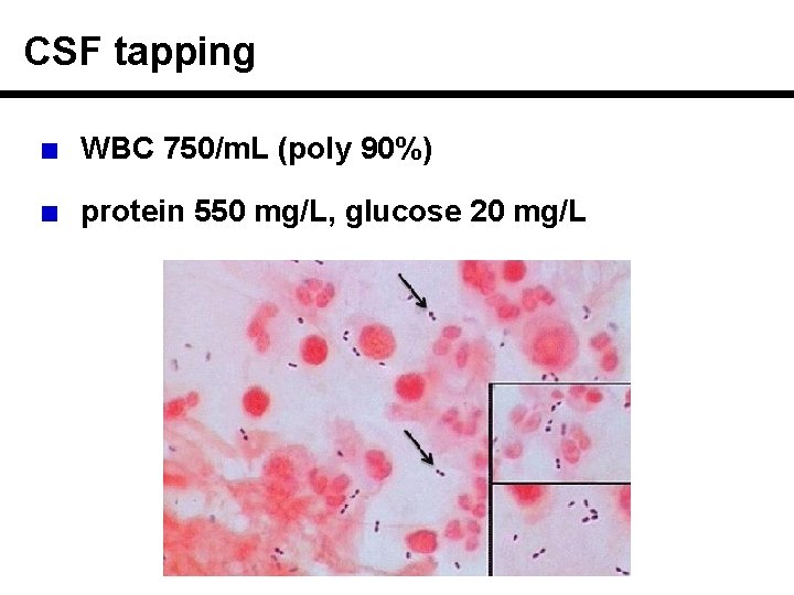 CSF tapping WBC 750/m. L (poly 90%) protein 550 mg/L, glucose 20 mg/L 