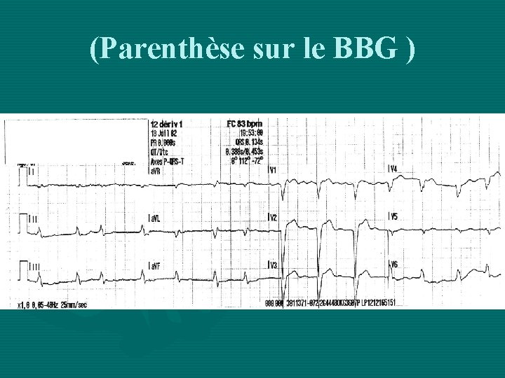 (Parenthèse sur le BBG ) 