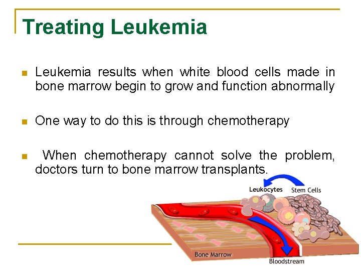 Treating Leukemia n Leukemia results when white blood cells made in bone marrow begin