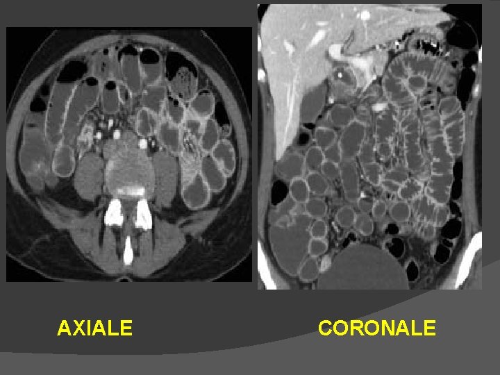 AXIALE CORONALE 