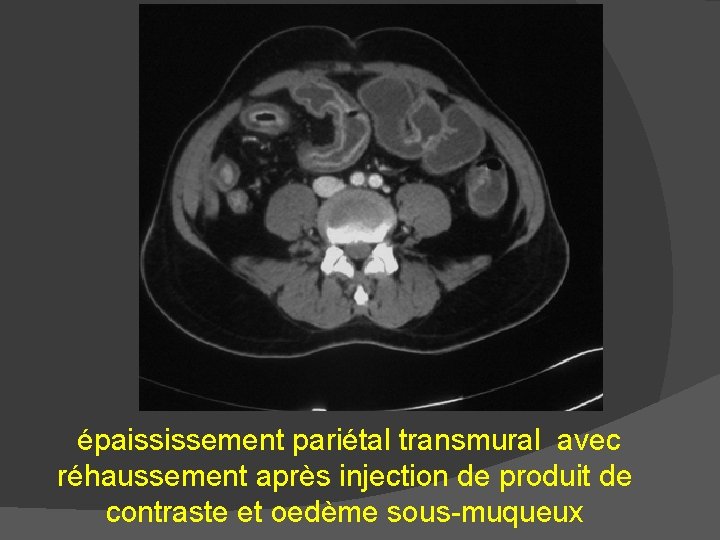épaississement pariétal transmural avec réhaussement après injection de produit de contraste et oedème sous-muqueux