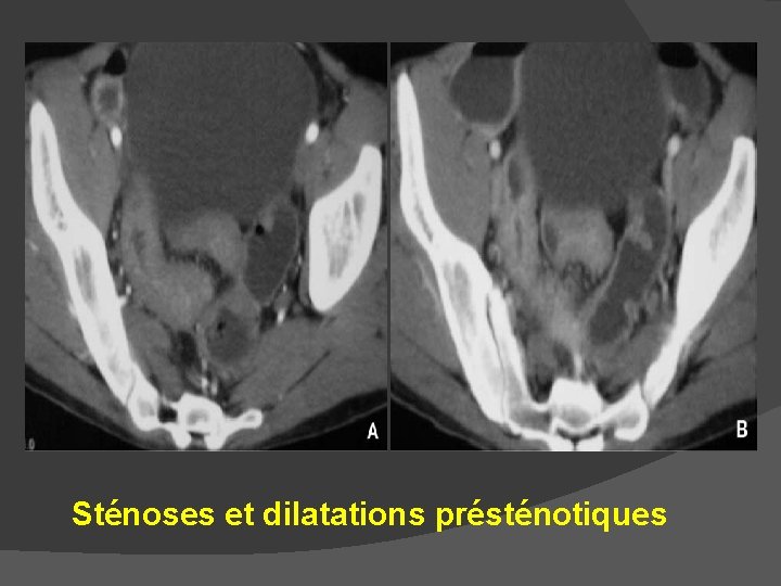 Sténoses et dilatations présténotiques 