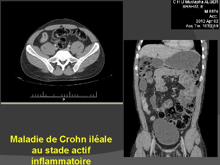 Maladie de Crohn iléale au stade actif inflammatoire 