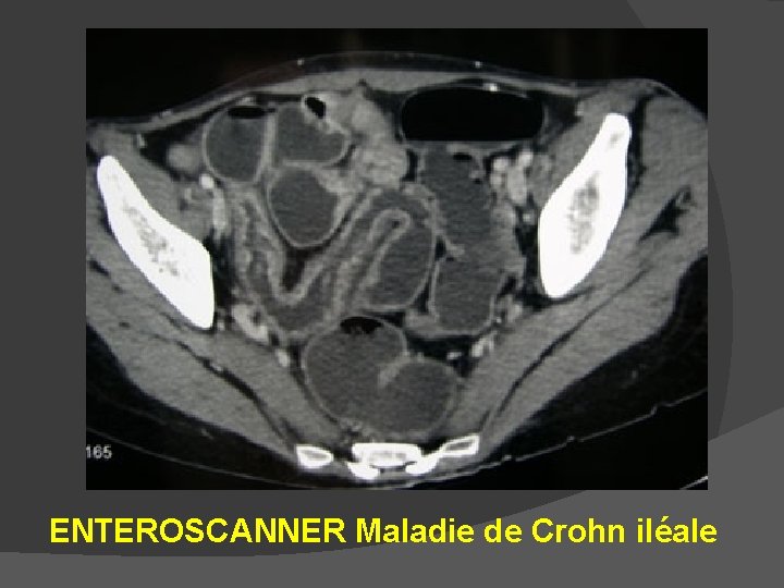 ENTEROSCANNER Maladie de Crohn iléale 