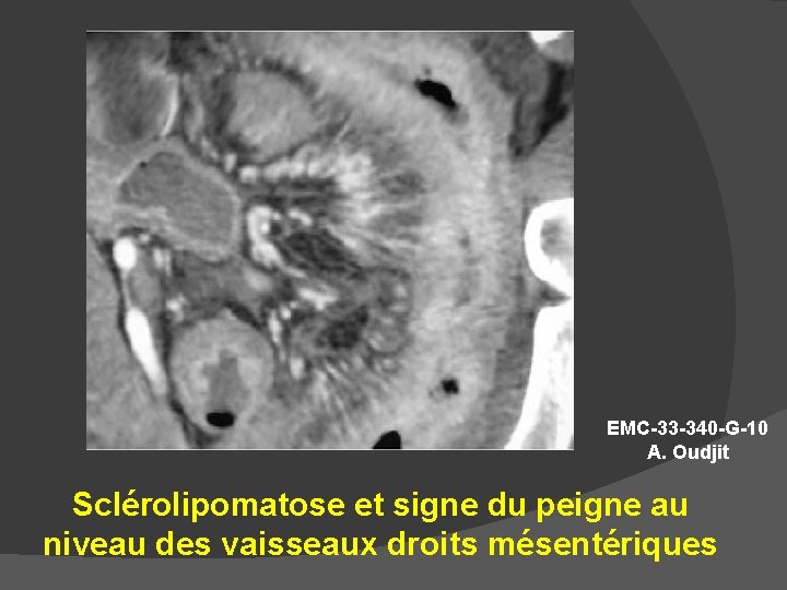 EMC-33 -340 -G-10 A. Oudjit Sclérolipomatose et signe du peigne au niveau des vaisseaux