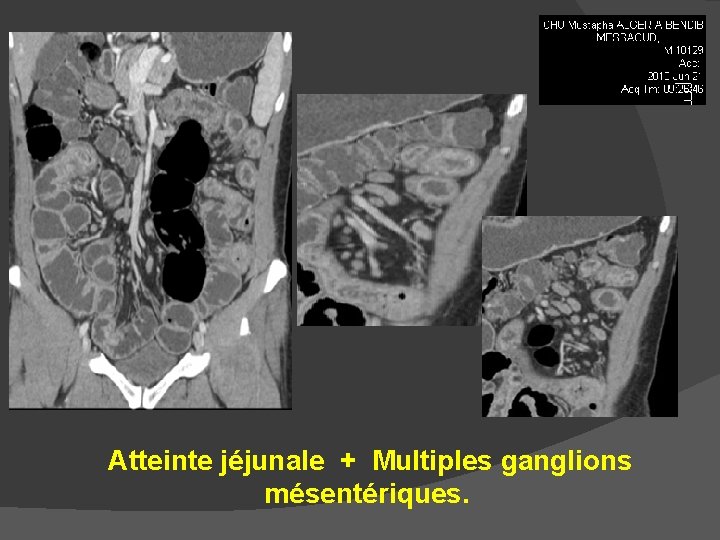 Atteinte jéjunale + Multiples ganglions mésentériques. 