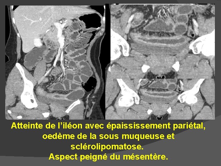 Atteinte de l’iléon avec épaississement pariétal, oedème de la sous muqueuse et sclérolipomatose. Aspect