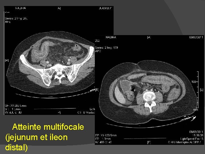 Atteinte multifocale (jejunum et ileon distal) 
