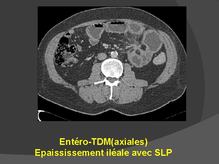 Entéro-TDM(axiales) Epaississement iléale avec SLP 