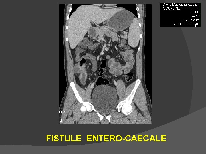 FISTULE ENTERO-CAECALE 