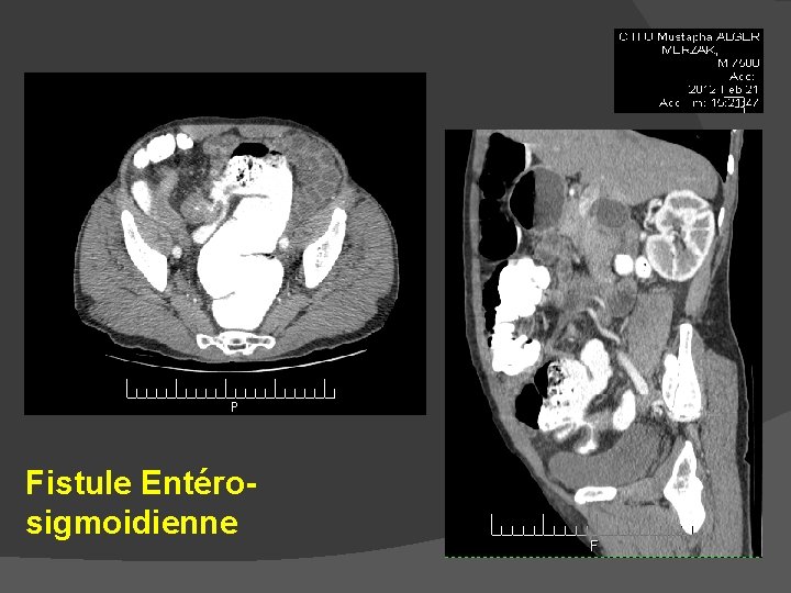 Fistule Entérosigmoidienne 