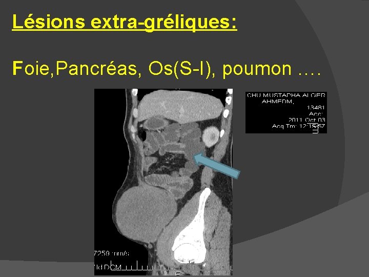 Lésions extra-gréliques: Foie, Pancréas, Os(S-I), poumon …. 