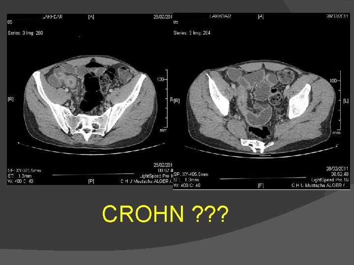 CROHN ? ? ? 