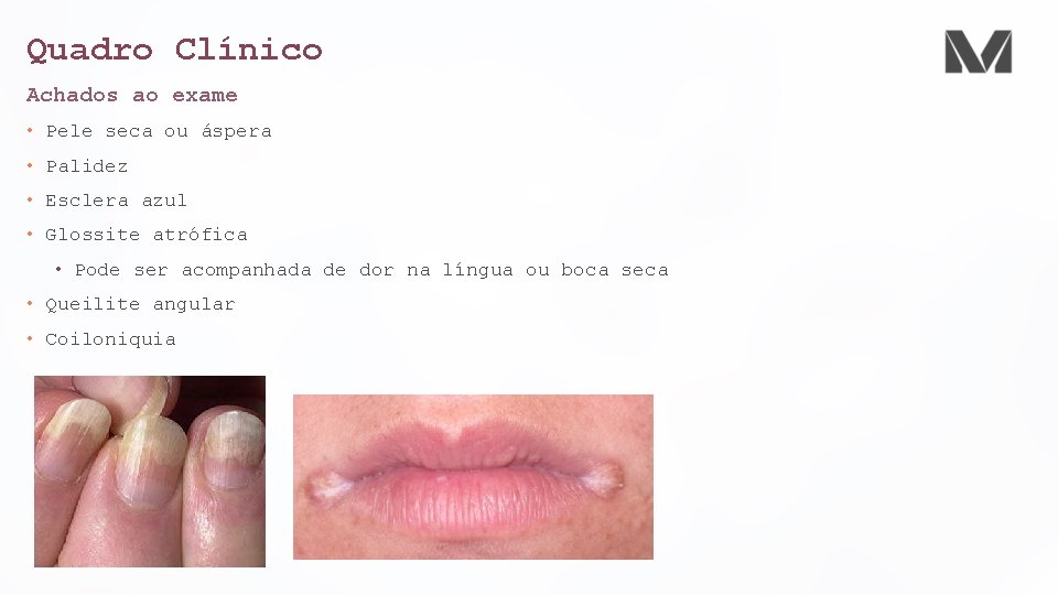 Quadro Clínico Achados ao exame • Pele seca ou áspera • Palidez • Esclera