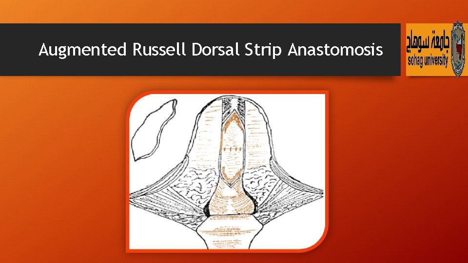 Augmented Russell Dorsal Strip Anastomosis 