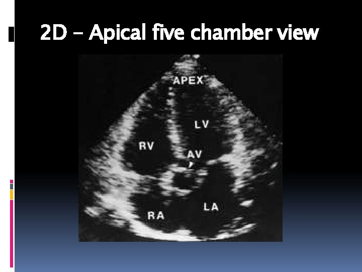 2 D - Apical five chamber view 