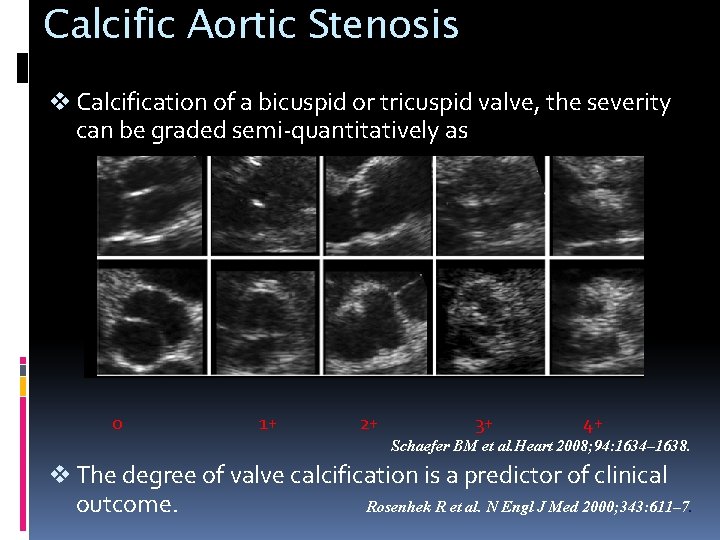 Calcific Aortic Stenosis v Calcification of a bicuspid or tricuspid valve, the severity can