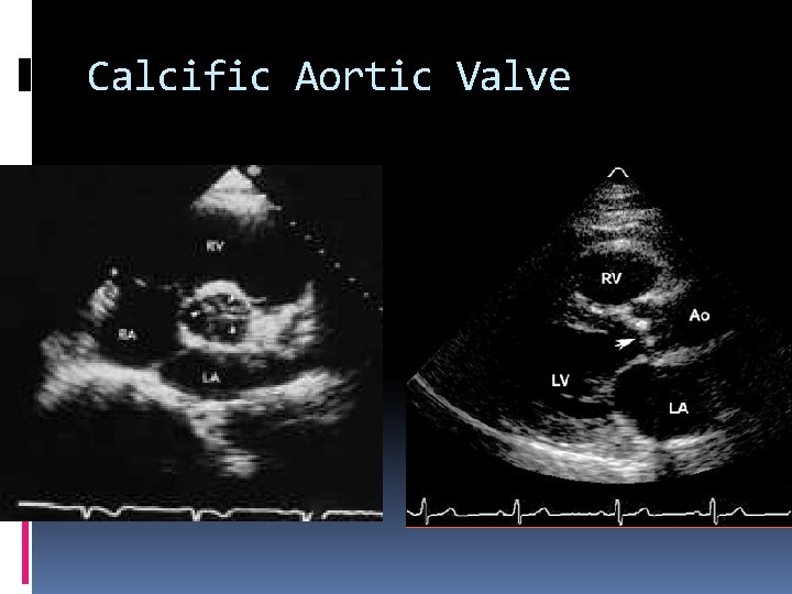 Calcific Aortic Valve 