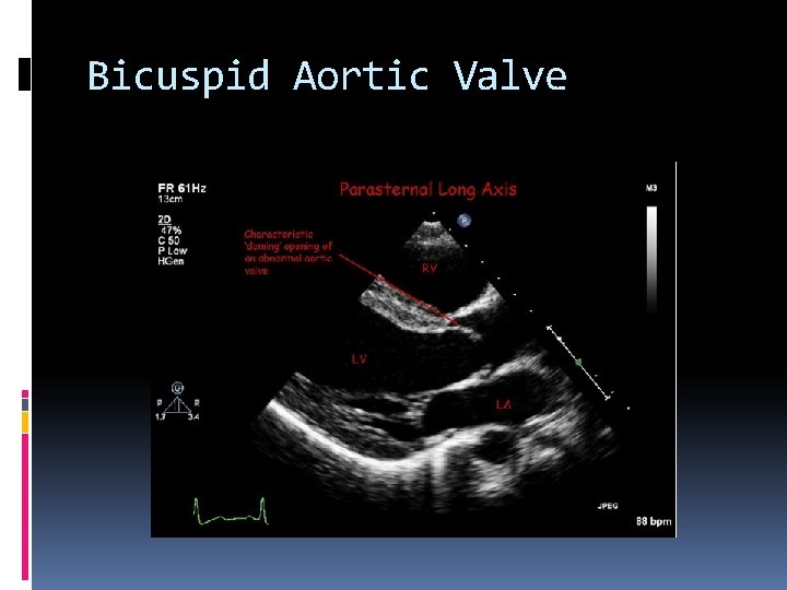 Bicuspid Aortic Valve 