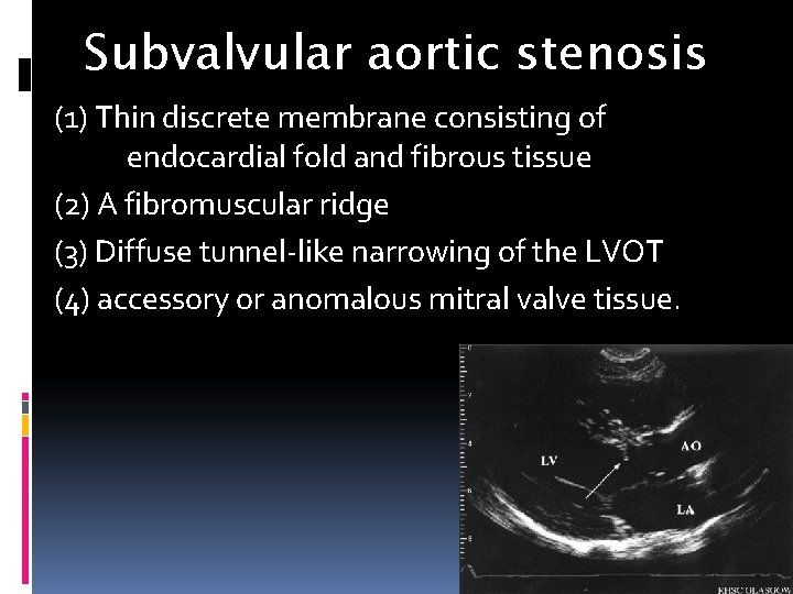 Subvalvular aortic stenosis (1) Thin discrete membrane consisting of endocardial fold and fibrous tissue