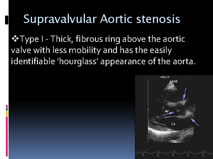 Supravalvular Aortic stenosis v. Type I - Thick, fibrous ring above the aortic valve