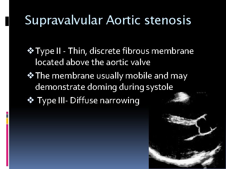 Supravalvular Aortic stenosis v Type II - Thin, discrete fibrous membrane located above the