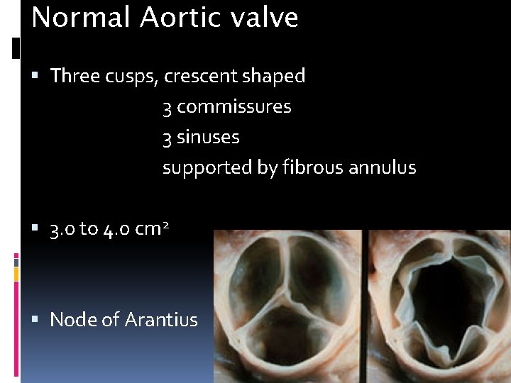 Normal Aortic valve Three cusps, crescent shaped 3 commissures 3 sinuses supported by fibrous