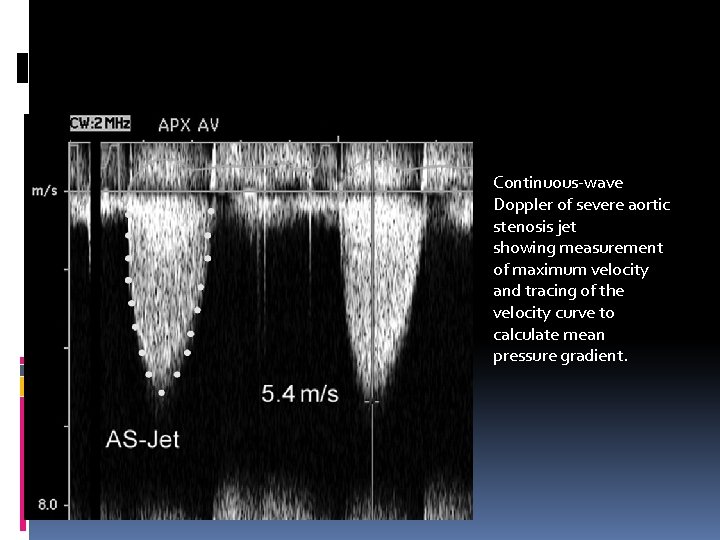 Continuous-wave Doppler of severe aortic stenosis jet showing measurement of maximum velocity and tracing