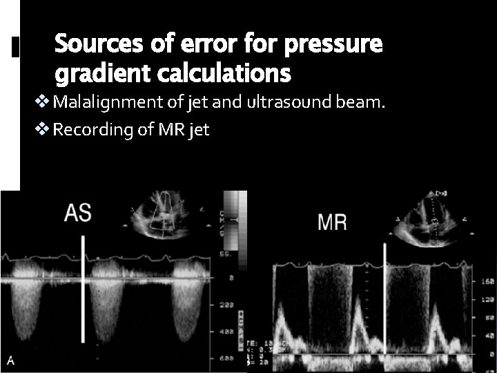 Sources of error for pressure gradient calculations v Malalignment of jet and ultrasound beam.