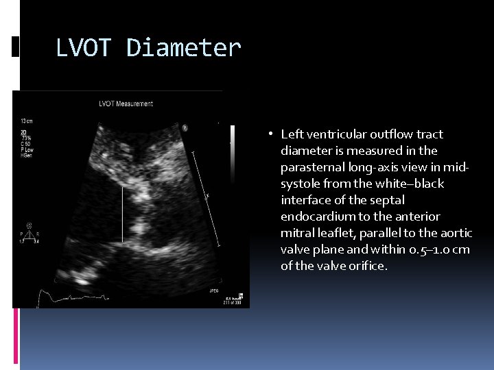 LVOT Diameter • Left ventricular outflow tract diameter is measured in the parasternal long-axis