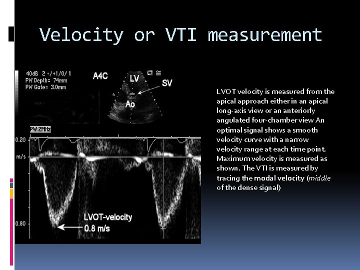 Velocity or VTI measurement LVOT velocity is measured from the apical approach either in
