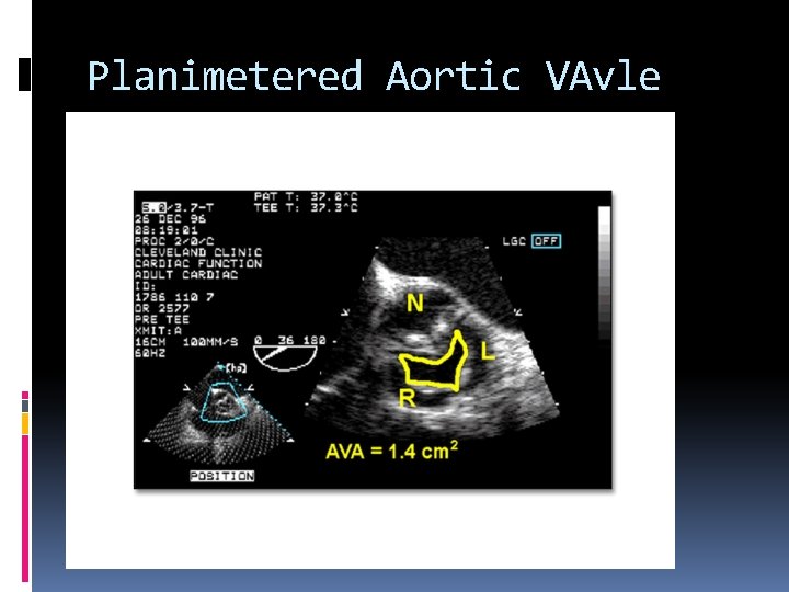 Planimetered Aortic VAvle 