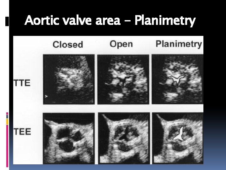 Aortic valve area - Planimetry 