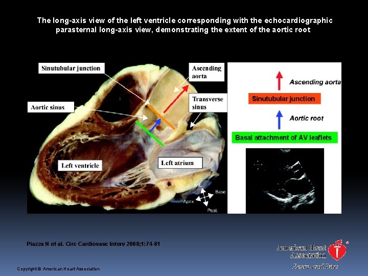 The long-axis view of the left ventricle corresponding with the echocardiographic parasternal long-axis view,