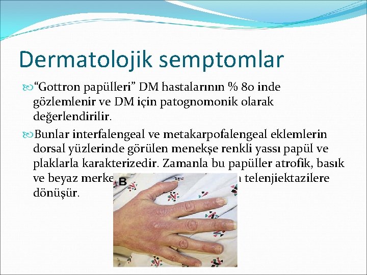 Dermatolojik semptomlar “Gottron papülleri” DM hastalarının % 80 inde gözlemlenir ve DM için patognomonik