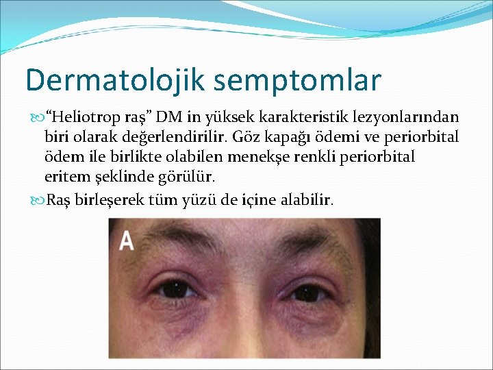 Dermatolojik semptomlar “Heliotrop raş” DM in yüksek karakteristik lezyonlarından biri olarak değerlendirilir. Göz kapağı