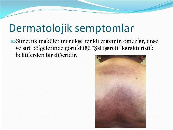 Dermatolojik semptomlar Simetrik maküler menekşe renkli eritemin omuzlar, ense ve sırt bölgelerinde görüldüğü “Şal