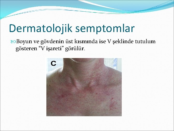 Dermatolojik semptomlar Boyun ve gövdenin üst kısmında ise V şeklinde tutulum gösteren “V işareti”