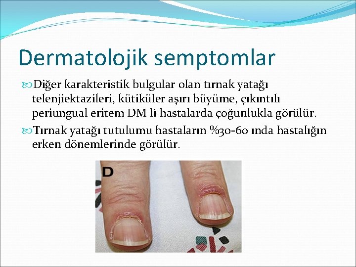 Dermatolojik semptomlar Diğer karakteristik bulgular olan tırnak yatağı telenjiektazileri, kütiküler aşırı büyüme, çıkıntılı periungual