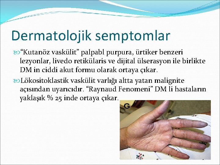 Dermatolojik semptomlar “Kutanöz vaskülit” palpabl purpura, ürtiker benzeri lezyonlar, livedo retikülaris ve dijital ülserasyon