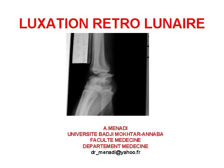 LUXATION RETRO LUNAIRE CARPE A. MENADI UNIVERSITE BADJI MOKHTAR-ANNABA FACULTE MEDECINE DEPARTEMENT MEDECINE dr_menadi@yahoo.