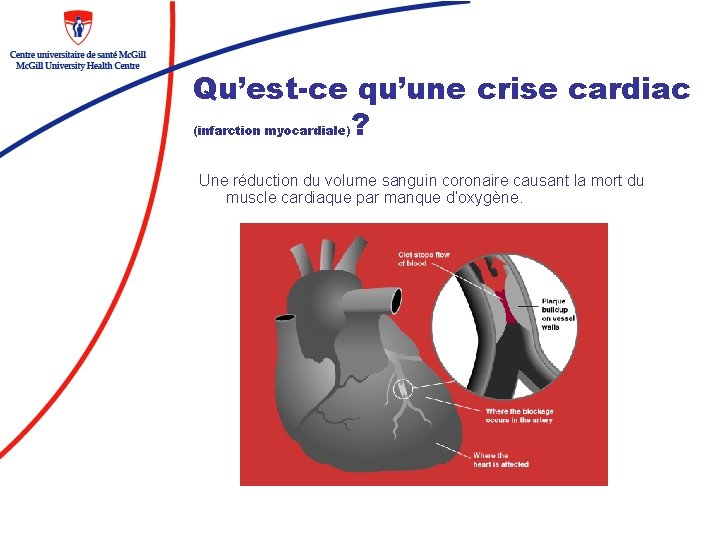 Qu’est-ce qu’une crise cardiac ? (infarction myocardiale) Une réduction du volume sanguin coronaire causant