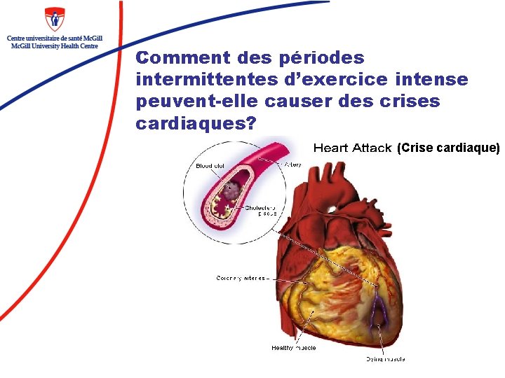 Comment des périodes intermittentes d’exercice intense peuvent-elle causer des crises cardiaques? (Crise cardiaque) 