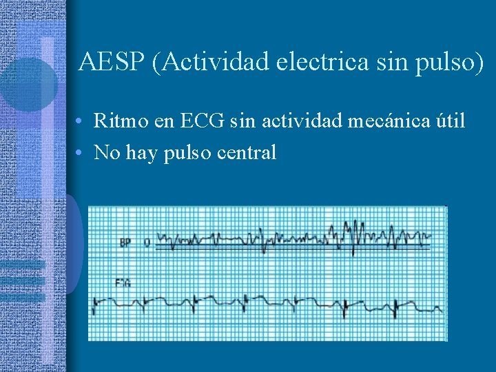 AESP (Actividad electrica sin pulso) • Ritmo en ECG sin actividad mecánica útil •