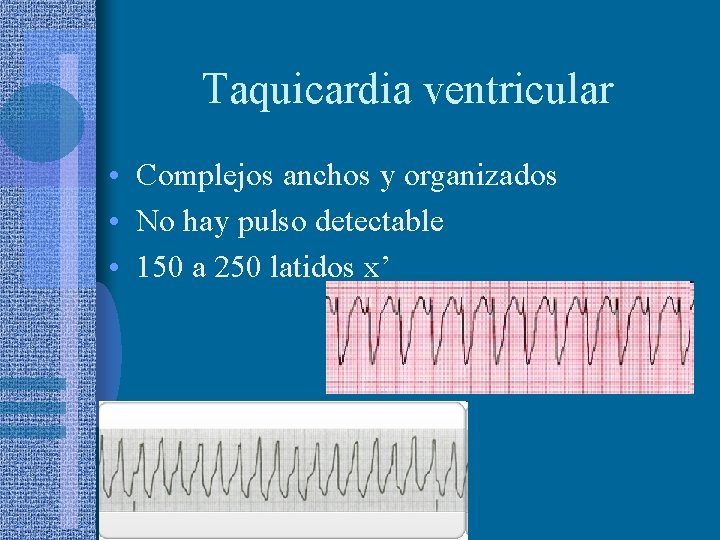 Taquicardia ventricular • Complejos anchos y organizados • No hay pulso detectable • 150