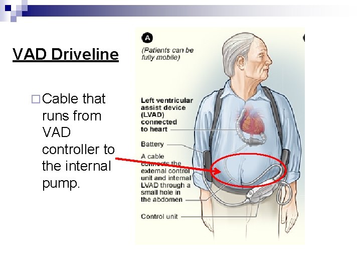 VAD Driveline ¨ Cable that runs from VAD controller to the internal pump. 