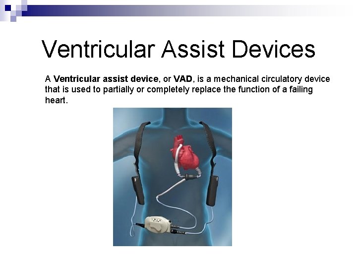 Ventricular Assist Devices A Ventricular assist device, or VAD, is a mechanical circulatory device
