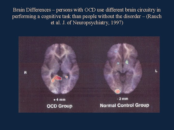 Brain Differences – persons with OCD use different brain circuitry in performing a cognitive