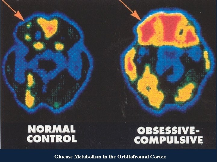 Glucose Metabolism in the Orbitofrontal Cortex 